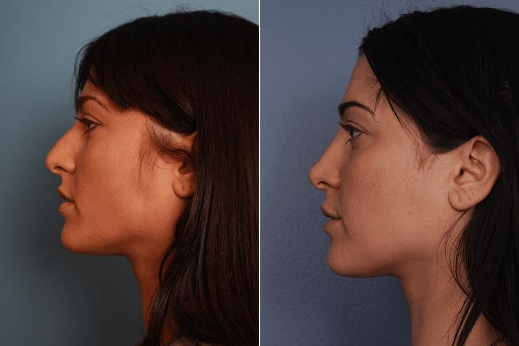 rhinoplasty expert