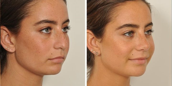 Left Side Navigation – closed rhinoplasty recovery.