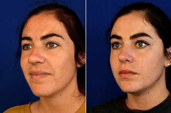 closed rhinoplasty recovery