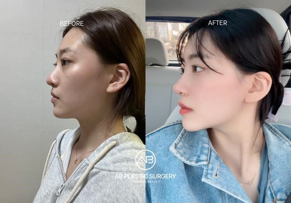 closed rhinoplasty recovery