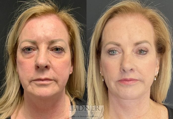 closed rhinoplasty recovery